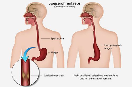 Schematische Darstellung des operativen Verfahrens bei Speiseröhrenkrebs Schematische Darstellung des operativen Verfahrens bei Speiseröhrenkrebs